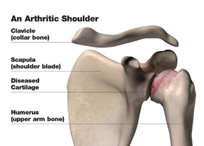 arthritic_shoulder_w
