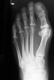 foot_ankle_bunion1
