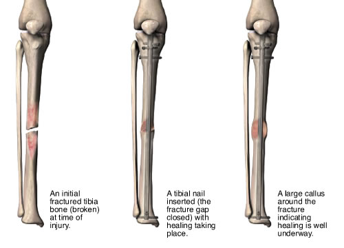 China Intramedullary Expert TN Tibial Nail System manufacturers and  suppliers | XC Medico