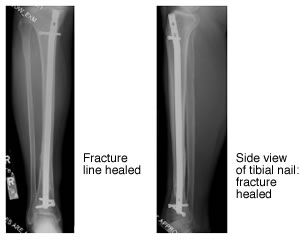 Retrograde tibial nailing of far distal tibia fractures: a biomechanical  evaluation of double- versus triple-distal interlocking | European Journal  of Trauma and Emergency Surgery