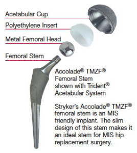 Minimally Invasive Hip Joint Replacement | Kambiz Behzadi, M.D ...